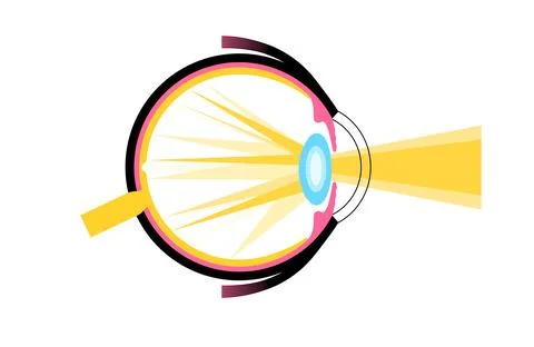 Cataract eye disease Stock Illustration