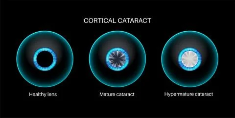 Cataract eye disease Stockillustratie