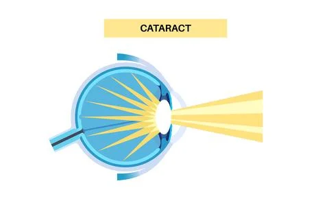 Cataract eye disease Stockillustratie