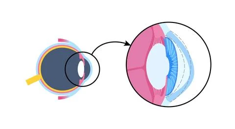 Cataract eye disease Stockillustratie