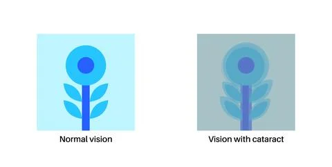 Cataract eye disease Stock Illustration