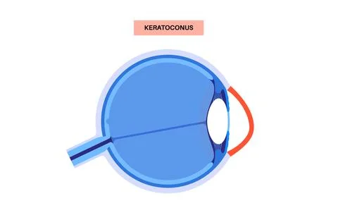 Cataract eye disease Stockillustratie