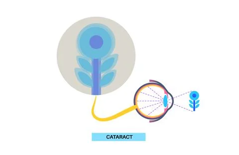 Cataract eye disease Illustrazione stock