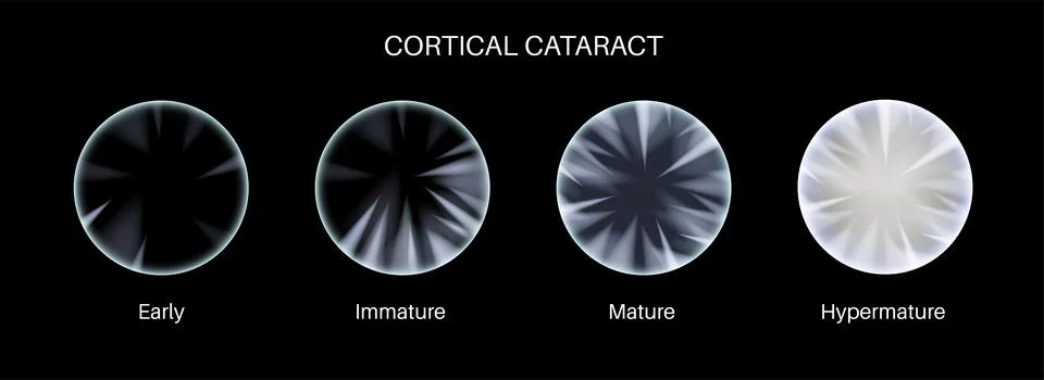 Cataract eye disease Stockillustratie