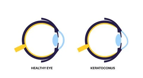 Cataract eye disease Stock Illustration