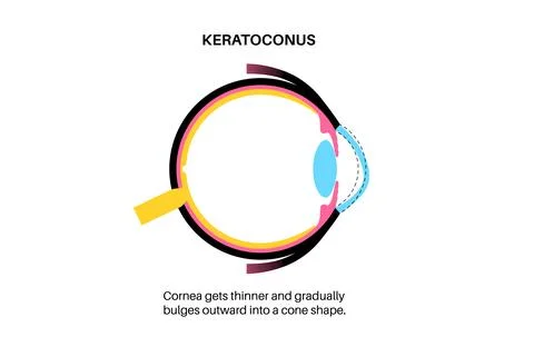 Cataract eye disease Stock Illustration