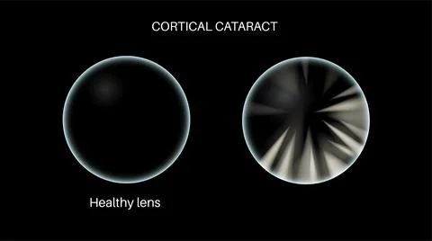 Cataract eye disease Stockillustratie