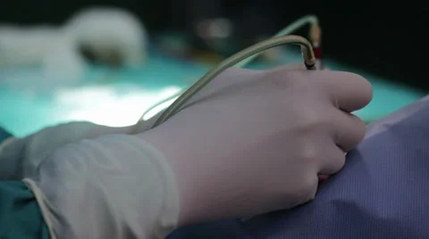 Cataract eye surgery. Surgeons team performing operation eye cataract. Long shot Stock Footage 34629259