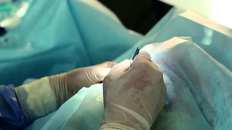 Cataract surgery close-up Stock Footage 97891240