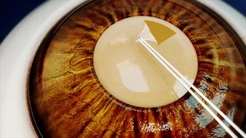 Cataract surgery. Complete surgical procedure with artificial lens implanted Stockbeeldmateriaal 345101639
