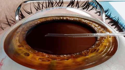 Cataract surgery: full procedure removes cloudy natural lens Stockbeeldmateriaal 345013104