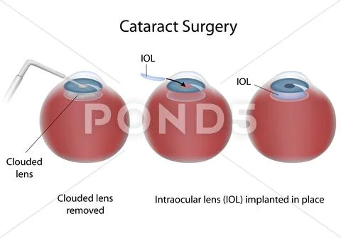 Cataract surgery Stock Illustration