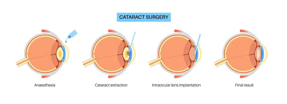 Cataract surgery poster Stock Illustration