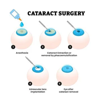 Cataract Surgery Procedure Process Progress Diagram Healthcare, Educational.. Stock Illustration