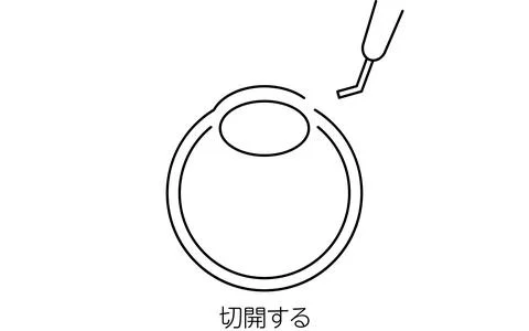 Cataract Surgery Process, Illustration (line drawing), Making an incision - Stock Illustration