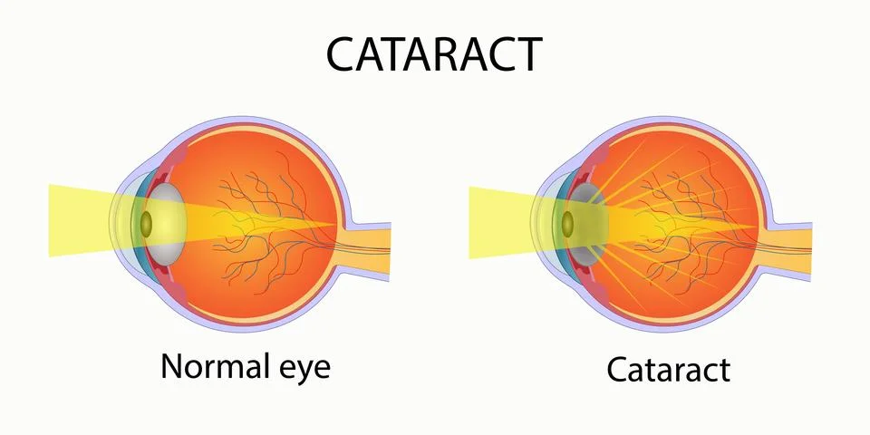Cataract, visual disorder, image of normal vision and vision with cataract. Stock Illustration