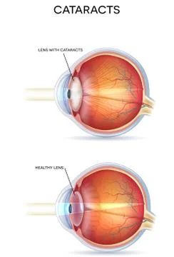 Cataracts Stock Illustration