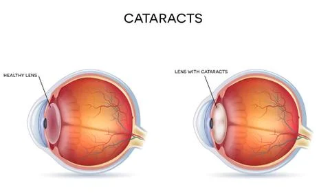 Cataracts Stock Illustration