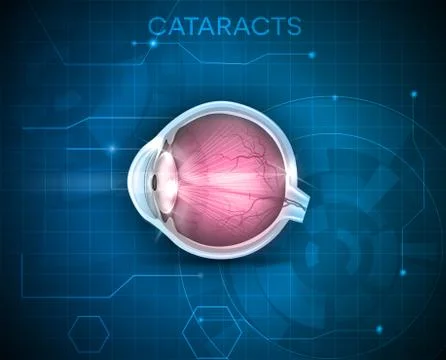 Cataracts Stock Illustration
