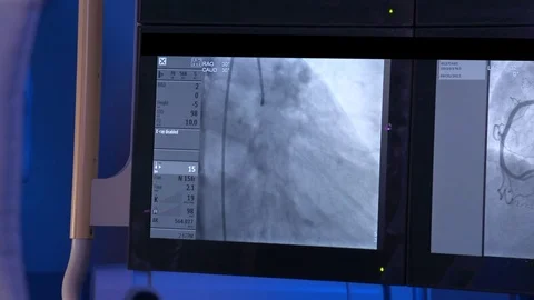 Cath Lab Image of Dye entering heart on monitor 2 Stock Footage 78937542