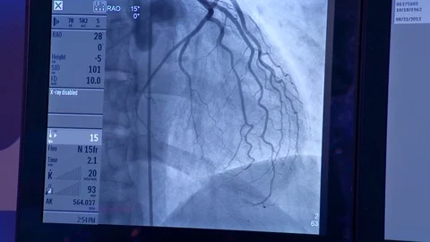Cath Lab Image of Dye entering heart on monitor 1 Stock Footage