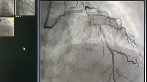 Catheter in the heart 01 Stock Footage 158902220