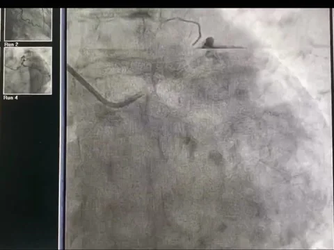 Catheter in the heart03 Stock Footage 158902230