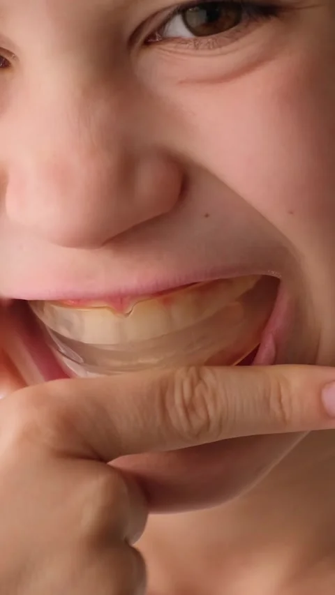 Caucasian child uses the aligner. A young boy puts a clear orthodontic Stock Footage 345650766
