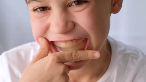 Caucasian child uses the aligner. A young boy puts a clear orthodontic Stock Footage 345650787