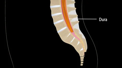 Caudal epidural injection 스톡 동영상 37930310