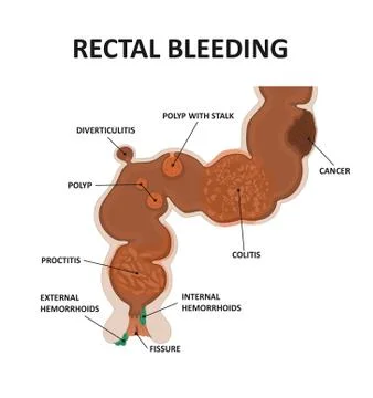 Cause rectal bleeding. Stock Illustration