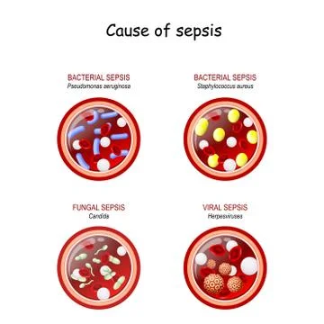 Cause of sepsis. Close-up of cross section of blood vessel with red blood cel Stock Illustration