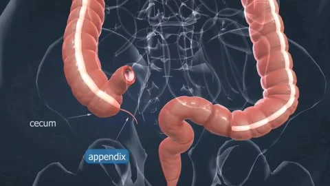 Causes and symptoms of appendix Stock Footage 269203478