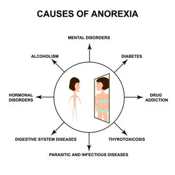 Causes of anorexia. Slim physique with anorexia. Reflection of obesity in the Stock Illustration