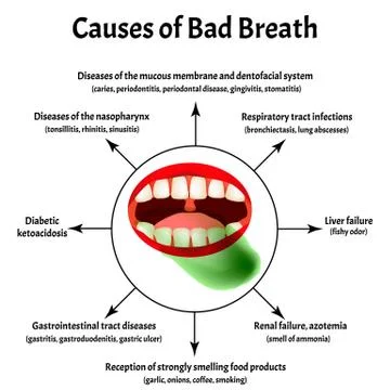 Causes of bad breath. Halitosis. The structure of the teeth and oral cavity Stock Illustration