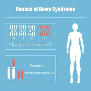 Causes of Down Syndrome Stock Illustration