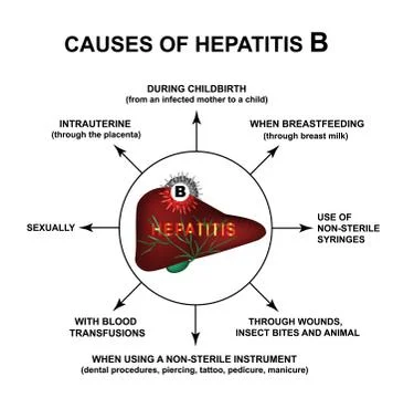 Causes of Hepatitis B. World Hepatitis Day. Infographics. Vector illustration on Stock Illustration