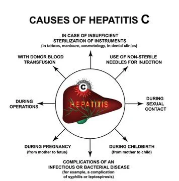 Causes of Hepatitis C. World Hepatitis Day. Infographics. Vector illustration on Stock Illustration
