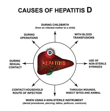 Causes of Hepatitis D. World Hepatitis Day. Infographics. Vector illustration on Stock Illustration