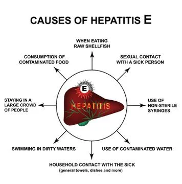 Causes of Hepatitis E. World Hepatitis Day. Infographics. Vector illustration on Stock Illustration