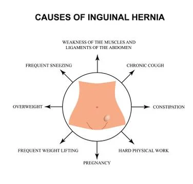 Causes of inguinal hernia. Infographics. Vector illustration on isolated Stock Illustration