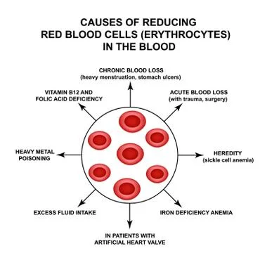 Causes of Reducing Red Blood Cells. Cells erythrocytes. Hemoglobin. The Stock Illustration