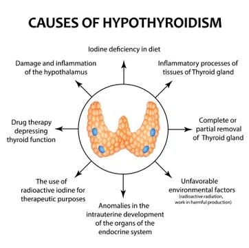 The causes of thyroid hypothyroidism. Infographics. Vector illustration on Stock Illustration