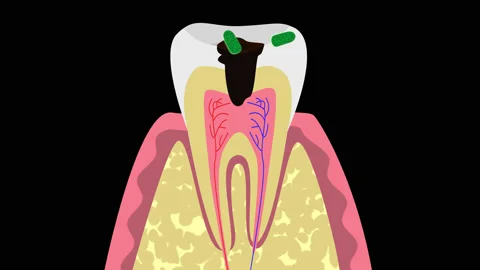Causes of tooth cysts 4K, alpha channal Stock Footage 132907430