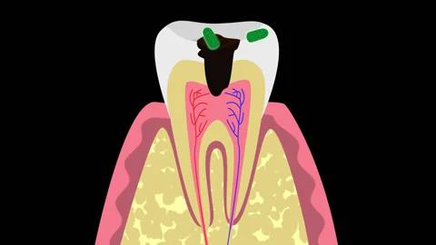 Causes of tooth cysts HD, alpha channal Stock Footage 132907413