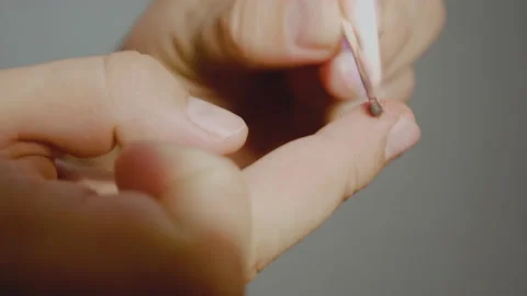 Cauterization of wart. The man cauterizes the wound on his finger with a match. Video stock 140684098