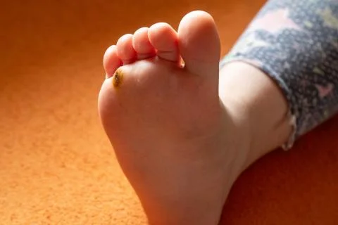 Cauterized wart on the leg. Stock Photos