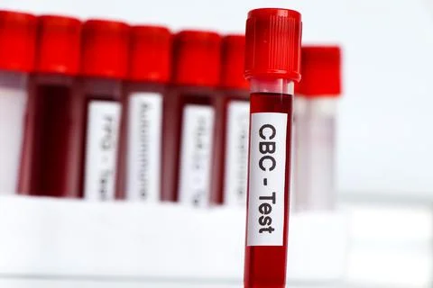 CBC test for abnormalities in red blood cells, Blood samples to be analyzed i Fotos de archivo