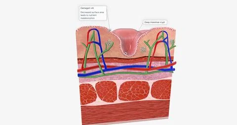 Celiac Disease is a chronic condition characterized an inflammatory allergi.. Illustrazione stock