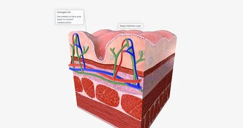 Celiac Disease is a chronic condition characterized an inflammatory allergi.. Illustrazione stock